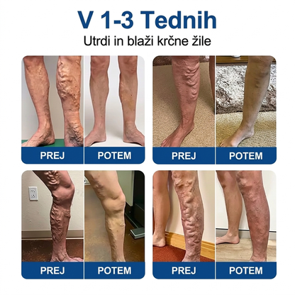 🌱 Medistart® Mikroiglični obliž za nego krčnih žil ⚡ Takojšnje olajšanje, dolgotrajni učinki